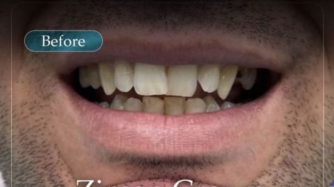 Transplantácia vlasov Turecko