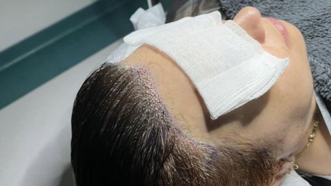 Transplantácia vlasov Turecko