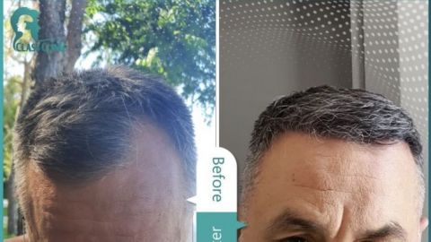 Transplantácia vlasov Turecko