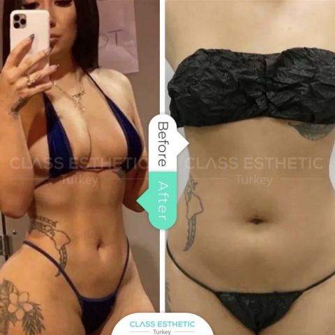 Liposukcia kozmetické úpravy Turecko