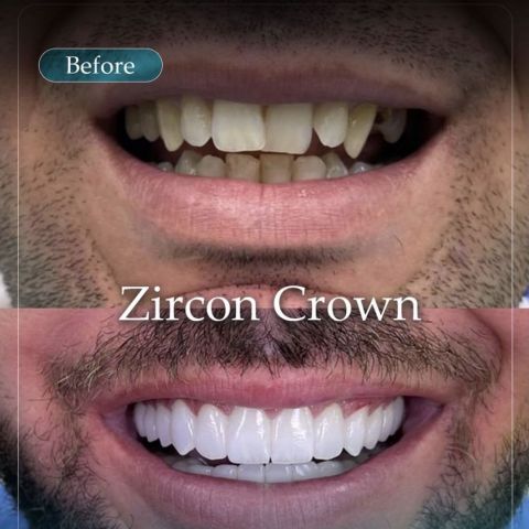 Zubné implantáty Turecko