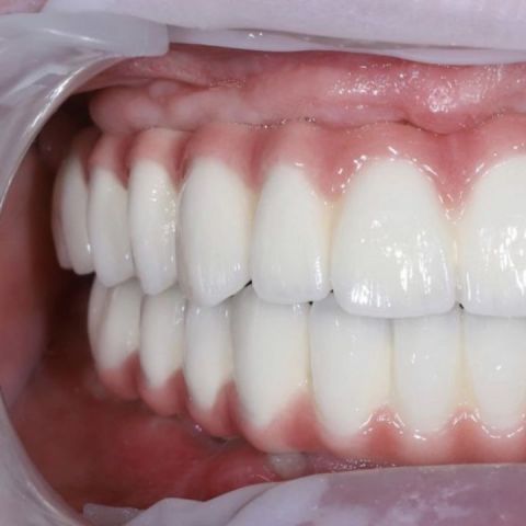 Akcia Bielenie zubov Košice